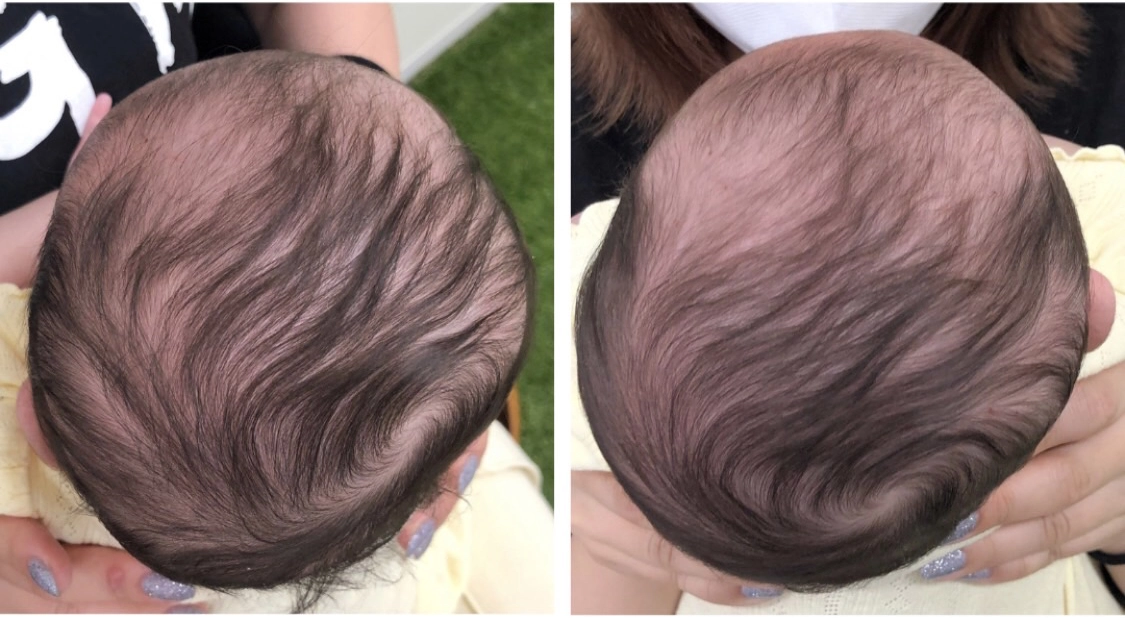 4ヶ月 初回の変化(Before/After)
