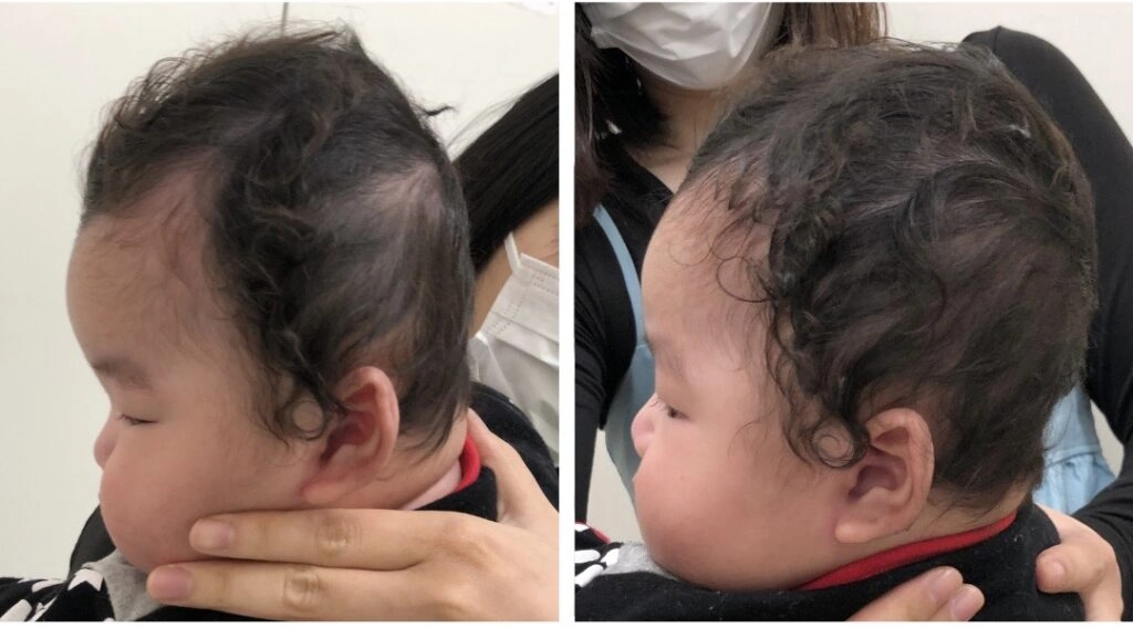 5ヶ月 2回目の変化(Before/After)