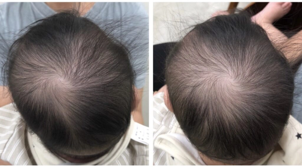 5ヶ月 初回の変化(Before/After)